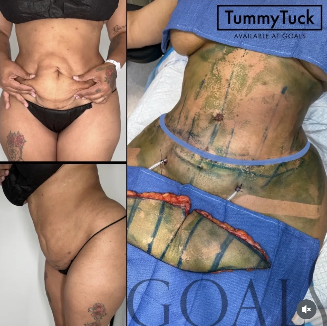 Before and after — Tummy Tuck, patient 6