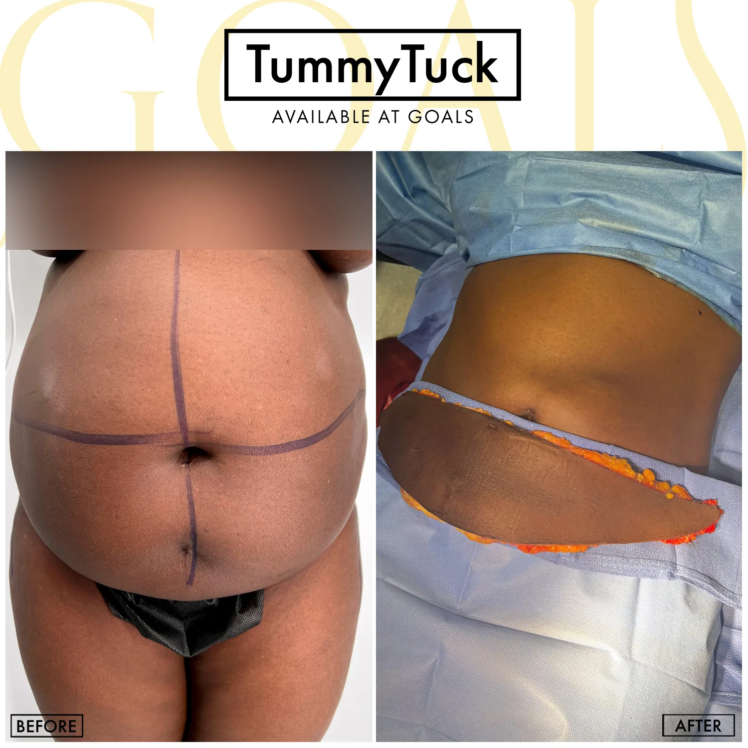Tummy Tuck — patient result