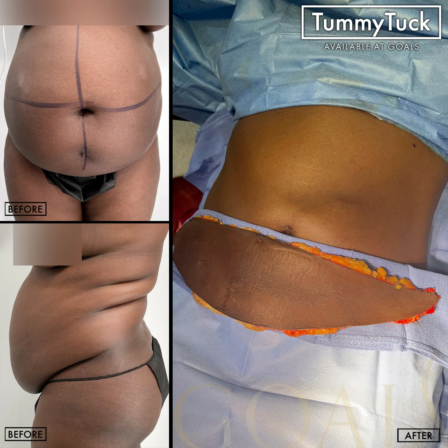 Before and after — Abdominoplastia · Bronx, patient 1