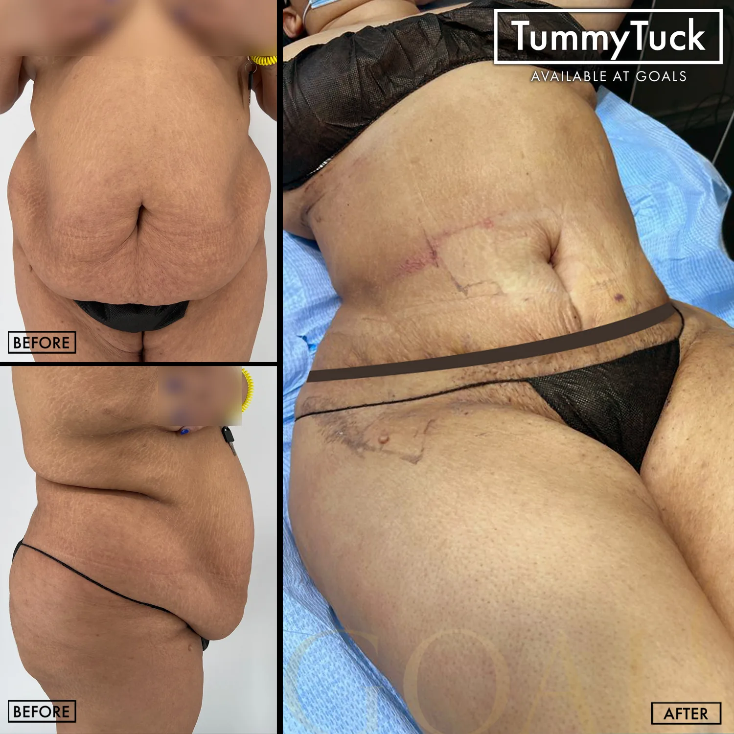 Before and after — Abdominoplastia · Bronx, patient 2