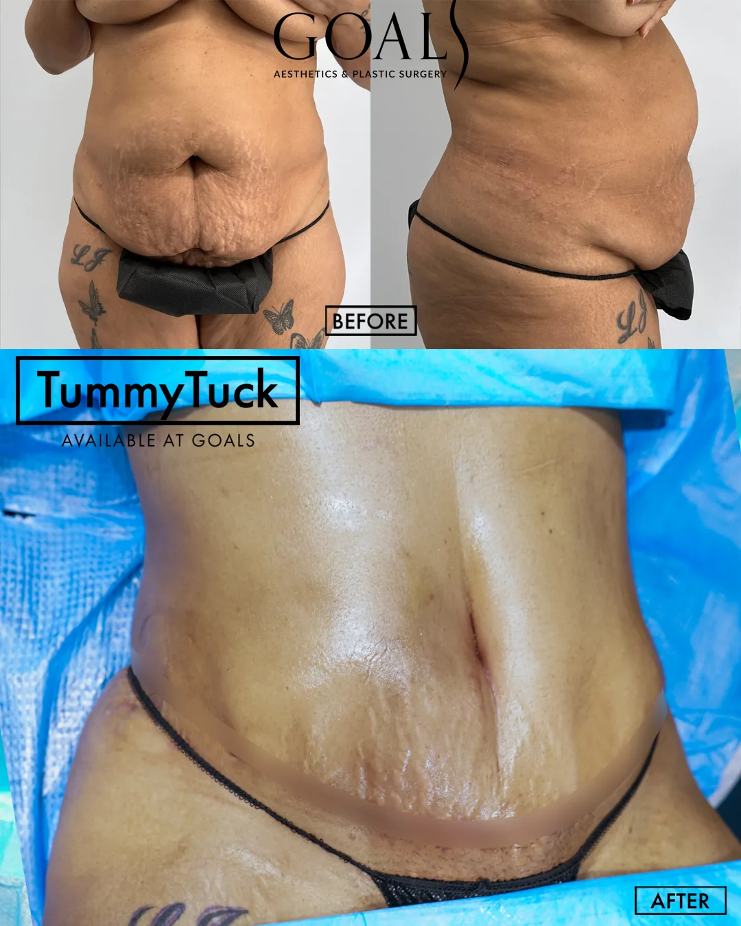 Before and after — Abdominoplastia · Los Angeles, patient 1