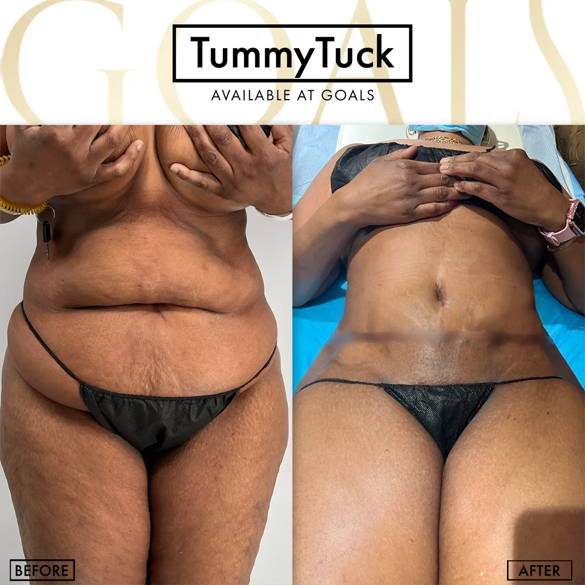 Before and after — Abdominoplastia · Los Angeles, patient 2