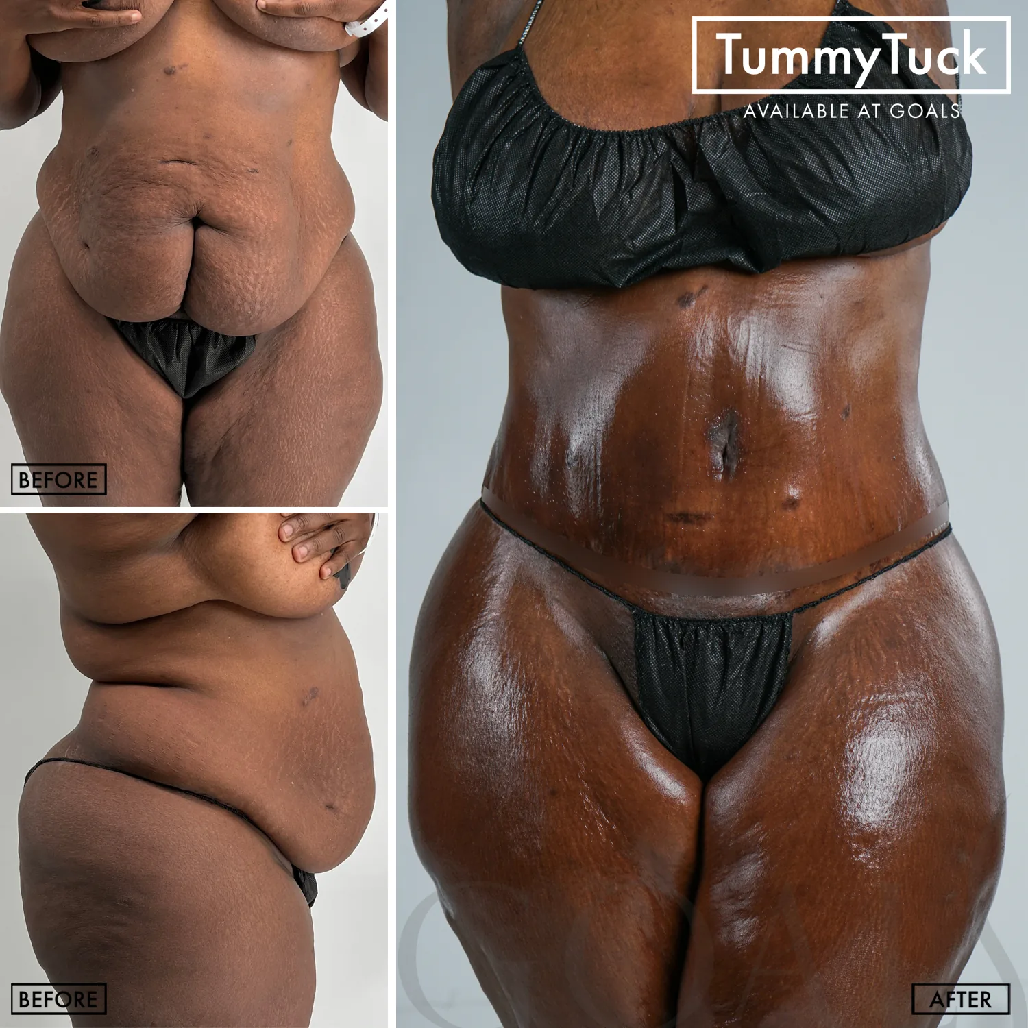 Before and after — Tummy Tuck · Brooklyn, patient 1