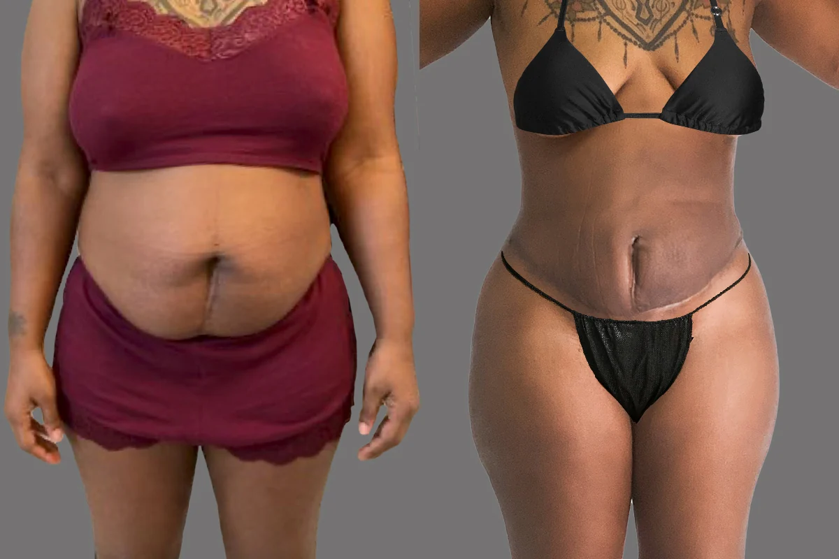 Before and after — Tummy Tuck, patient 1