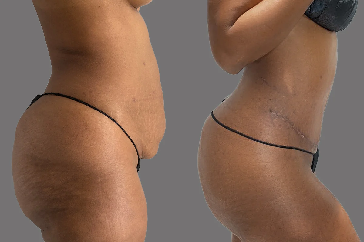 Before and after — Tummy Tuck, patient 2