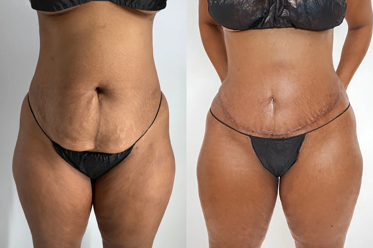 Before and after — Tummy Tuck, patient 3