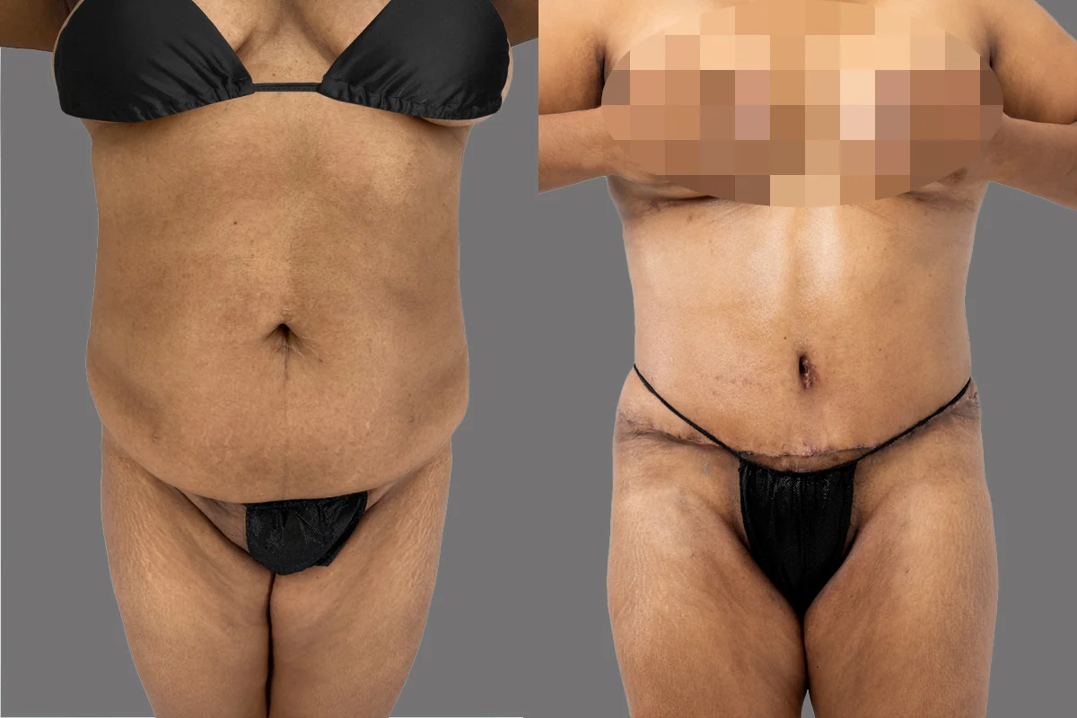 Before and after — Tummy Tuck, patient 4