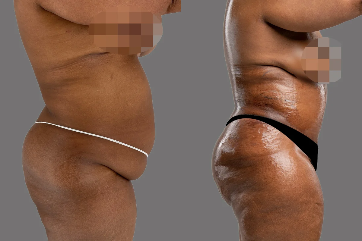Before and after — Tummy Tuck, patient 5