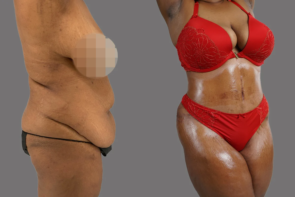 Before and after — Tummy Tuck, patient 6