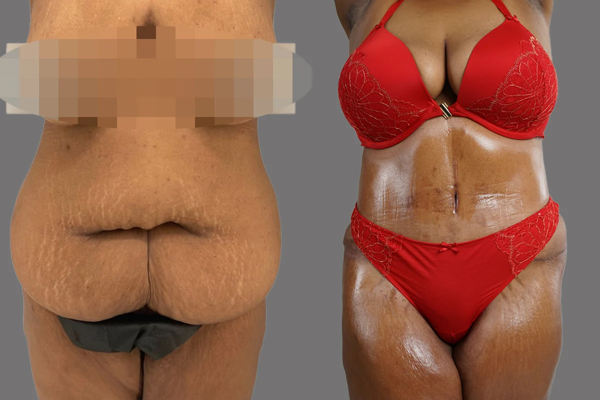 Before and after — Tummy Tuck · Philadelphia, patient 5