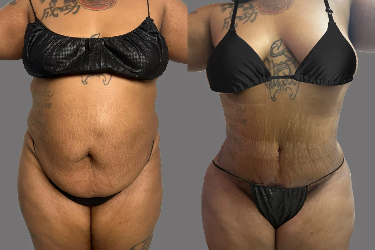 Before and after — Tummy Tuck · Philadelphia, patient 6