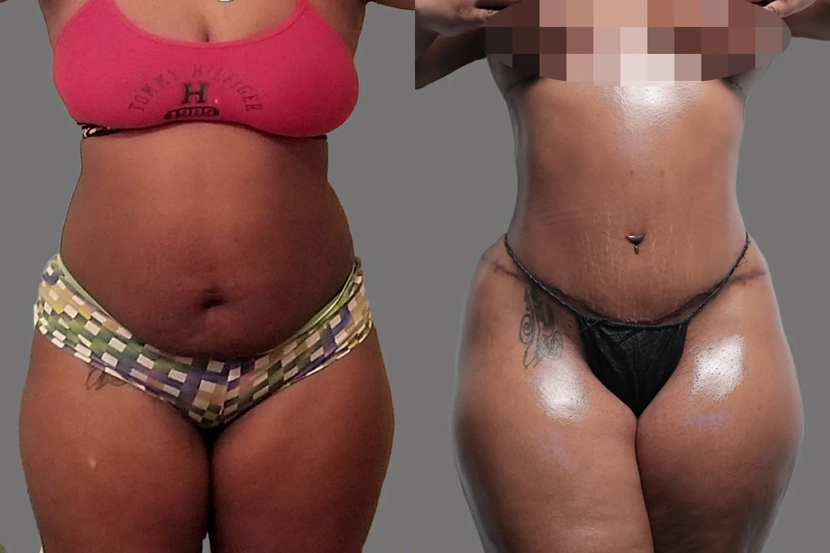Before and after, patient 4