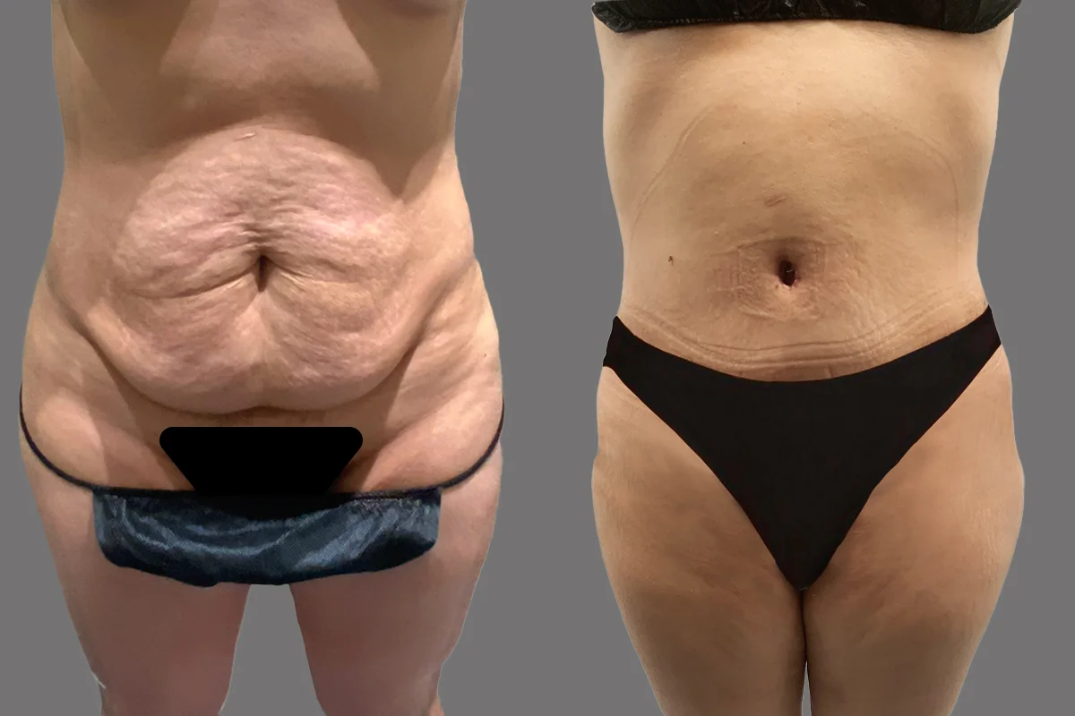 Tummy Tuck — patient result