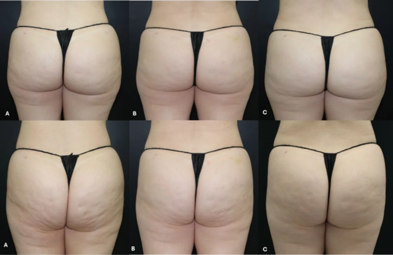 Published study patient's buttocks before treatment, 30 days after and 90 days after, relaxed and clenched